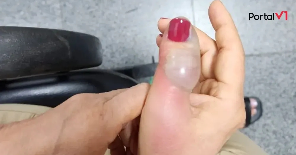 Após fazer as unhas, mulher contrai infecção grave e passa por 4 cirurgias