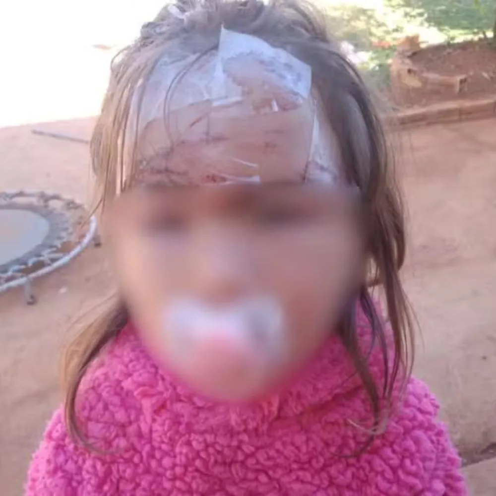 Criança de 3 anos leva 27 pontos no rosto após ser atacada por cachorro no dia do aniversário, no Paraná