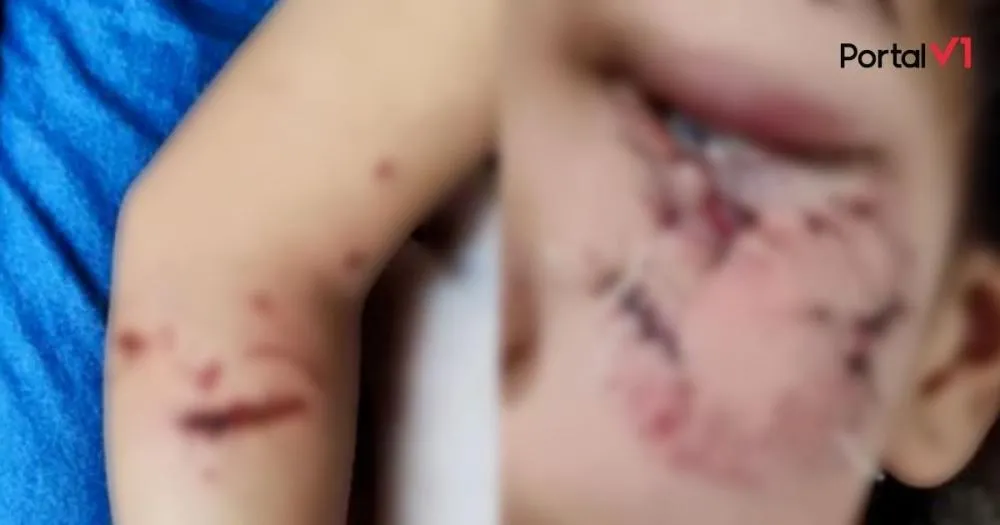 Criança é atacada por cachorro no Paraná