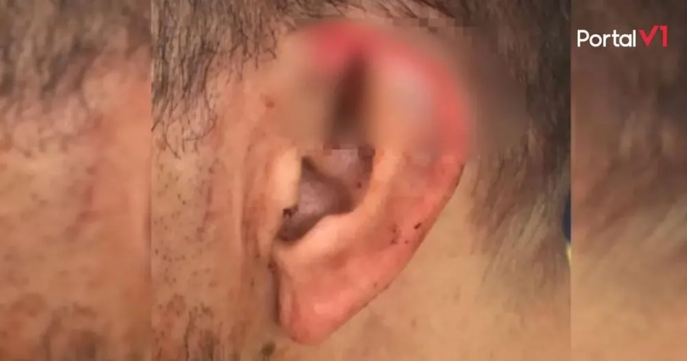 Homem arranca pedaço da orelha do namorado durante briga