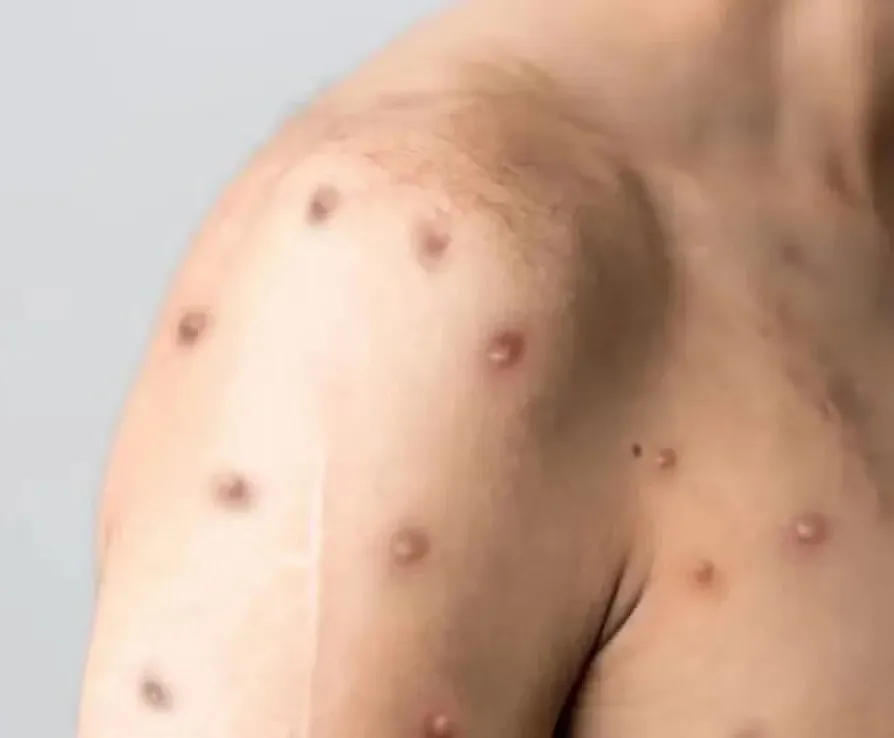 Paraná confirma primeiro caso de mpox em 2026 e autoridades intensificam monitoramento