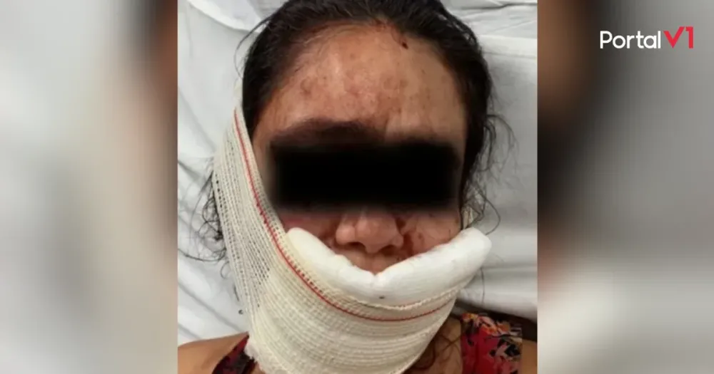 Mulher tem lábios arrancados por mordidas após rir do namorado