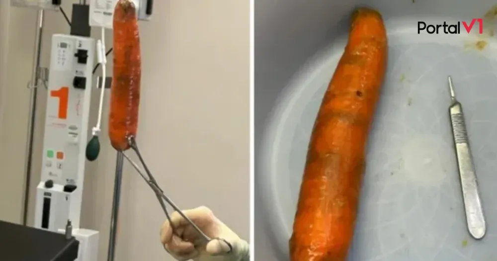 Homem encontra cenoura de 20 cm no ânus e diz não saber como foi parar ali.