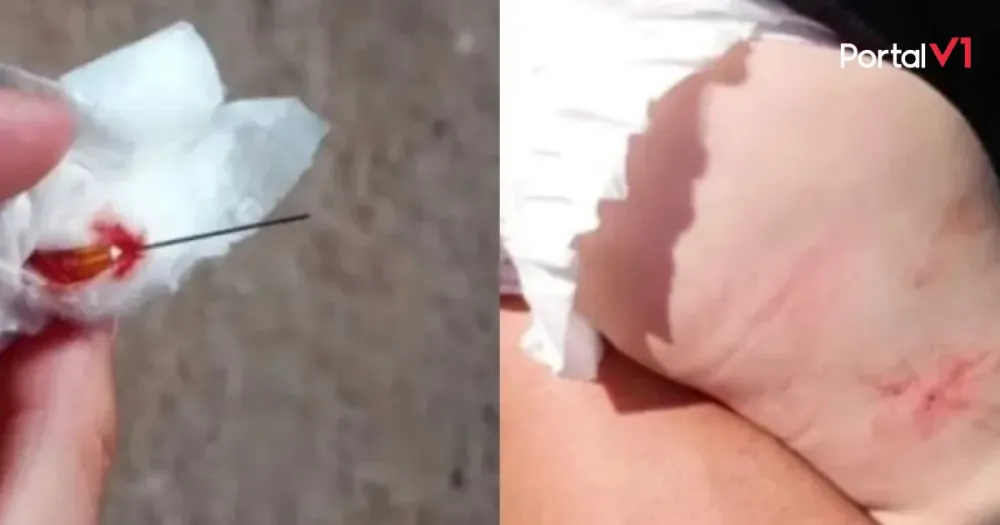 Enfermeira esquece agulha na perna de bebê após vacinação